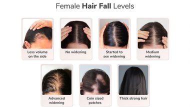 Business News | Traya's Study Reveals a Concerning Finding: One in Two Women Aged 36-40 Suffer from Advanced Widening or Female Pattern Hair Loss