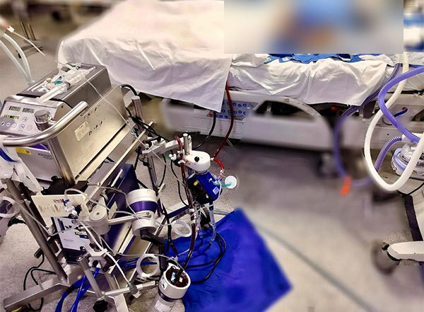 India News | Delhi: 11-year-old Gets Second Life with Help of Artificial Heart and Lung Technology