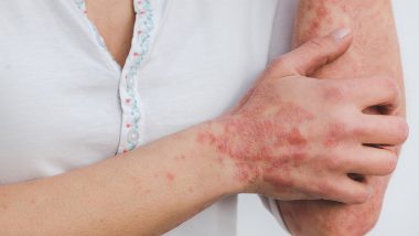 Psoriasis Causes and Symptoms: What Is Psoriasis? Here's What You Should Know About the Autoimmune Skin Condition That Causes Rashes and Pain