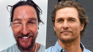 Matthew McConaughey Faces Bee Sting, Shares Swollen Eye Photo