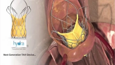 Business News | SMT Won the Italian National CONSIP 2-Year Tender to Supply Hydra TAVI in All Italian Hospitals