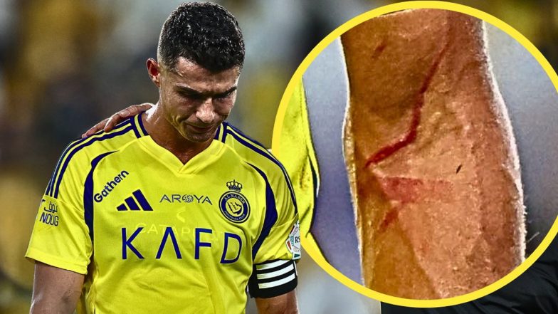 Cristiano Ronaldo's Arm Spotted Bleeding at Full-Time During Al-Nassr vs Al-Raed Saudi Pro League 2024-25 Clash, Pic Goes Viral