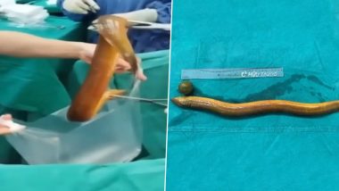 Indian Man in Vietnam Inserts 2-Foot-Long Live Eel Into His Anus, Undergoes Emergency Surgery After It Starts Eating Intestine (See Pics)