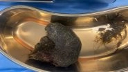 Bengaluru Doctors Remove Cricket Ball-Sized Hairball From 8-Year-Old Girl&rsquo;s Stomach Who Ate Her Own Hair Due to Trichophagia