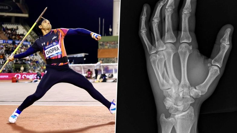 Star Athlete Neeraj Chopra Reveals Having Fourth Metacarpal Fracture During Diamond League Final