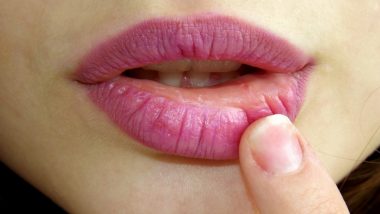 Winters 2024: How To Heal Chapped Lips at Home? 5 Home Remedies To Treat Cheilitis During the Cold Months in India