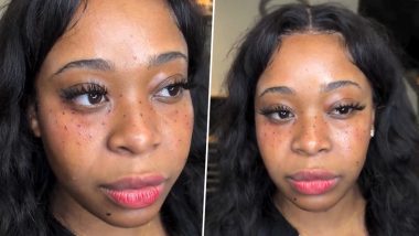 Freckle Tattoos: Woman Gets Freckles Inked on Her Face As Bizarre Beauty Trend Takes Over the Internet (Watch Video)