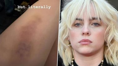 Billie Eilish Shares Bruise Photo After Falling Off Stage at Madison Square Garden (View Pic)