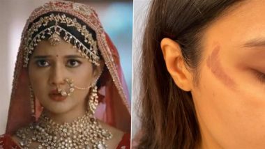 ‘Yeh Rishta Kya Kehlata Hai’ Actress Samridhii Shukla Shares Photos of Burn Injuries on Face and Hand From On-Set Mishap