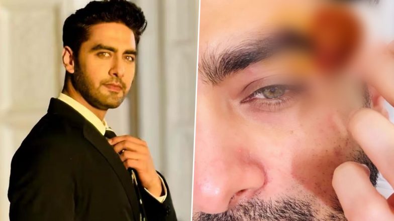 ‘Yeh Rishta Kya Kehlata Hai’ Star Rohit Purohit Suffers Eye Injury; Actor Clarifies the Mishap Didn’t Happen on Set