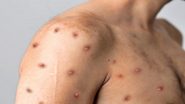 US Confirms First Case Of New Mpox Strain 'Clade 1' in California