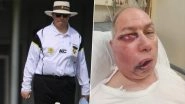 Umpire Tony DeNobrega Suffers Serious Facial Injury After Being Struck by Ball During Third-Grade Cricket Match in Australia (View Pics)