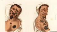 Syphilis: Did Columbus Bring the STI to Europe?