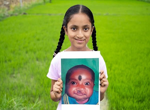 Business News | Smile Train India and Sirat Join Forces to Raise Cleft Awareness and Empower the Cleft Community Across India