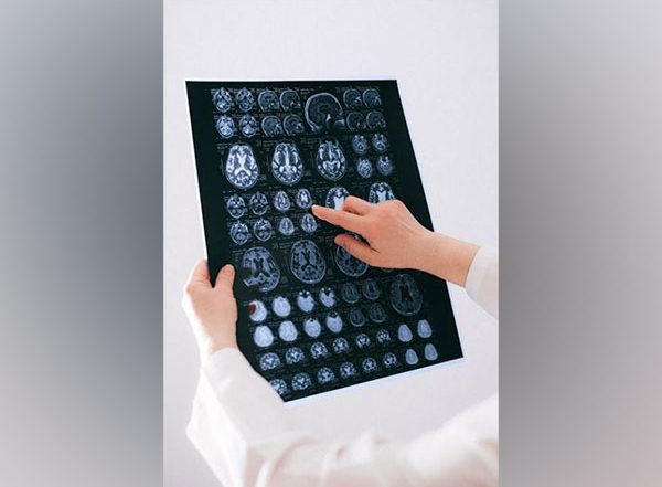 Health News | Brain Map Clarifies Neuronal Connectivity Behind Motor Function: Study