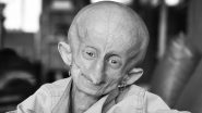 Beandri Booysen Dies at 19: South African TikTok Star Passes Away After Battling With Rare Ageing Disease Progeria, Family Shares Heartfelt Post (View Pic)