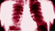 Major Tuberculosis Outbreak in Kansas City Area, US