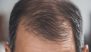 Hair Loss Mystery Triggers Panic in Villages in Maharashtra’s Buldhana, Health Officials Begin Probe As Residents Experiencing Sudden Baldness