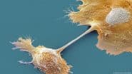 Scientists Find Promising Pancreatic Cancer Leads