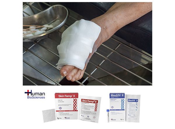 Business News | Human BioSciences Unveils Critical Support for Diabetic Wound Healing