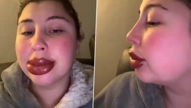 Lipstick Tattoo Leaves UK Woman With Ballooned Lips, Viral Video Captures Her Swollen Lips After Extreme Allergic Reaction Caused By Beauty Treatment (Watch)