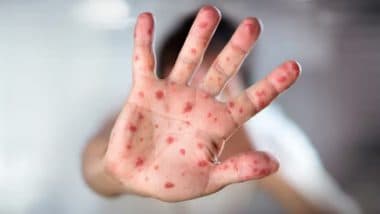 First Measles Death Reported in Texas, Most Cases Involve Children