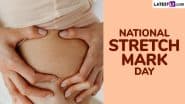 National Stretch Mark Day 2025 Date: Know Significance of the Day That Aims To Celebrate and Embrace the Natural Marks on Our Bodies