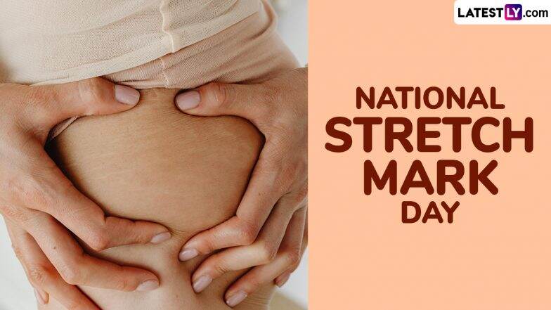 When Is National Stretch Mark Day 2025? All You Need To Know About the Day 