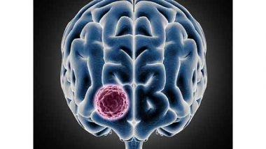 Business News | Sakra Successfully Conducts a Landmark Surgery for 10*9 Cm Giant  Meningioma on a 34-year-old  International Patient from Ghana