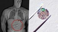 Thief in US Swallows Tiffany & Co Diamond Earrings Worth INR 6.7 Crore During Orlando Heist To Avoid Arrest, Viral Video Shows X-Ray Revealing the Jewellery in His Digestive Tract