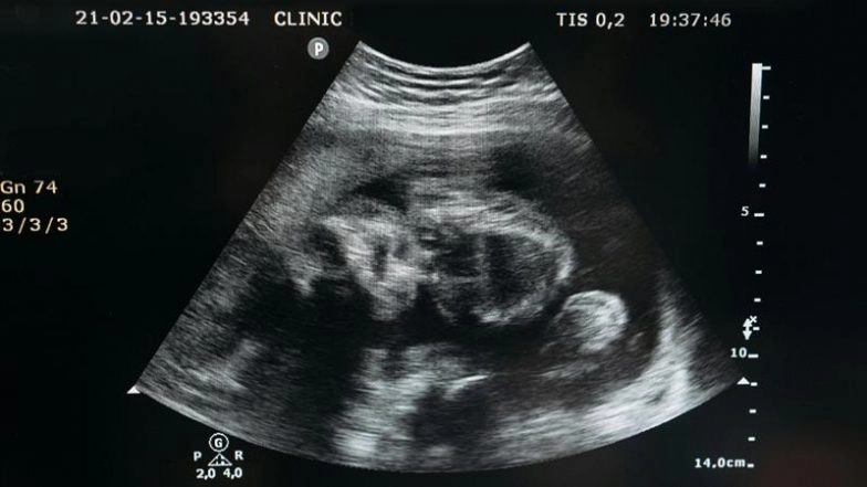 Zinc Spark Meaning: What Exactly Happens When Sperm Meets Egg? Unveiling the Fertilisation-Induced Zinc Firework in Humans That Marks the Creation of Life