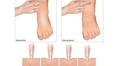 Business News | What is the Most Common Cause of Fluid Retention and How It Affects Your Blood Pressure?