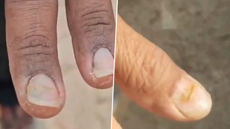 Mystery Health Crisis Deepens in Maharashtra&rsquo;s Buldhana: After Hair Loss, Nail Loss Reported in 4 Villages; Over 2 Dozen Affected, Probe Underway