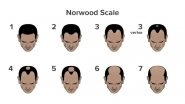 Business News | What is Causing Your Hair Fall? Take This Scientifically Backed Hair Loss Quiz