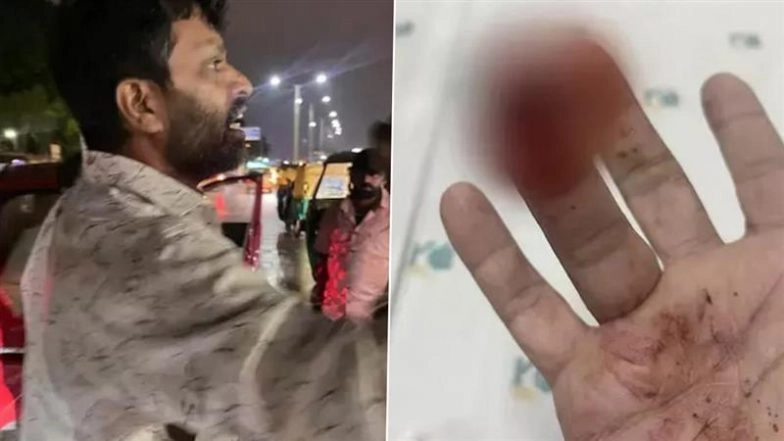 Bengaluru Road Rage: Man Bites Businessman’s Finger After His Car Splashes Rainwater, Victim Undergoes Surgery Worth INR 2 Lakh (See Pic)