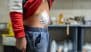 Appendix Cancer Rises in Young People — but Why?