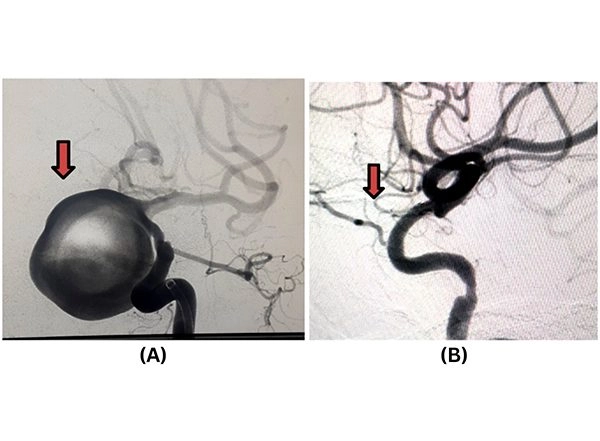 Business News | Pioneering Neurointerventional Excellence at Jehangir Hospital