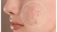Business News | How to Treat Acne and Pigmentation?