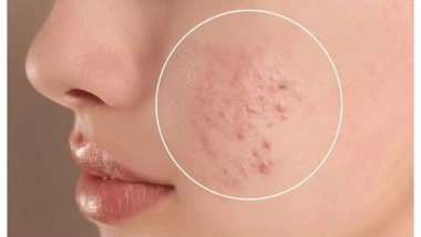 Business News | How to Treat Acne and Pigmentation?