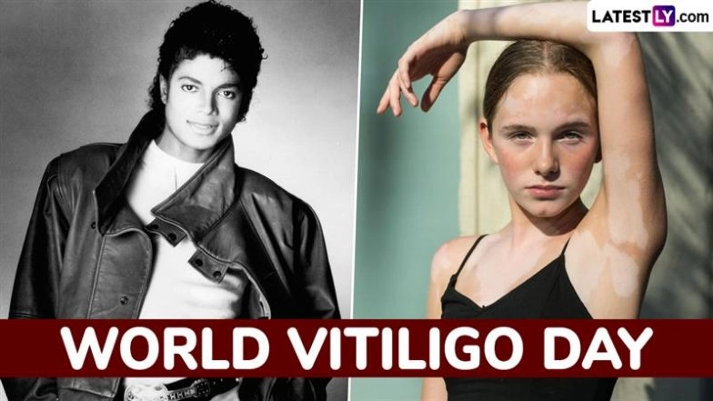 World Vitiligo Day 2025: From Michael Jackson to Ava Bright, 5 Famous Personalities With Vitiligo To Raise Awareness and Promote Inclusivity