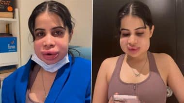 ’The Traitor’s Winner Uorfi Javed Shares New Video of Her Swollen Face After Lip Filler Removal Procedure – Here’s How Her Boyfriend Reacted!