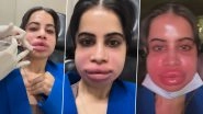 Uorfi Javed Shares Painful Lip Filler Dissolving Procedure in Bold Video, Fans Praise Her Honesty and Courage (Watch Video)