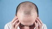 Business News | Dermatologist Vs. Hair Transplant Surgeon: Who's Best for Hair Transplant Surgery?