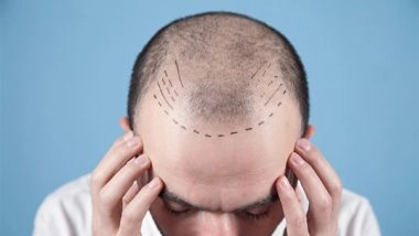 Business News | Dermatologist Vs. Hair Transplant Surgeon: Who's Best for Hair Transplant Surgery?