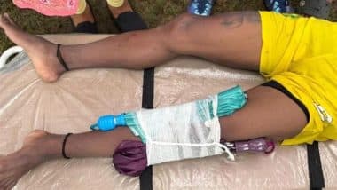 Bizarre! Railway FC Footballer Tarak Hembram's Injured Left Leg Supported With Umbrellas As He Was Stretchered Off During CFL 2025-26 Clash Against Mohun Bagan (See Pic)
