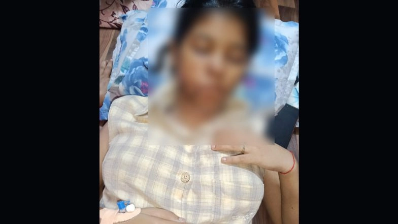 Kanpur Dog Attack: BBA Student Suffers Severe Facial Injuries, Gets 17 Stitches After Being Mauled by Stray Dogs; Disturbing Photo Surfaces