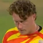 Tom Aslop Leaves Field With Bloodied Nose After a Jamie Overton Delivery Hits His Helmet During London Spirit vs Trent Rockets The Hundred 2025 Match (Watch Video)
