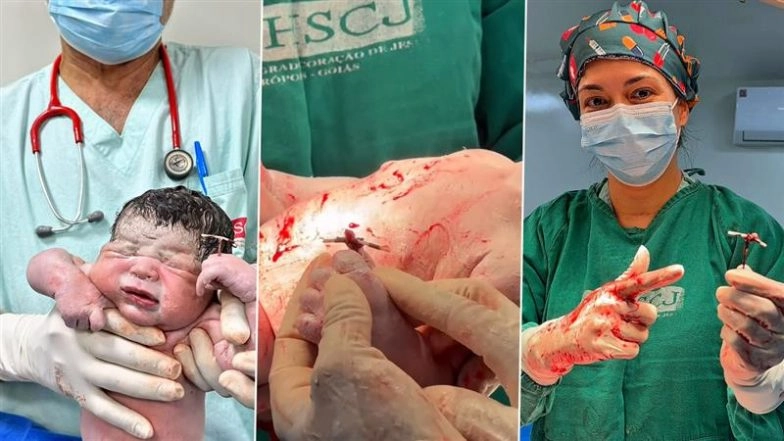 Brazil: Newborn Baby Holds Contraceptive IUD That Failed To Prevent Mother’s Pregnancy in Neropolis, Video Surfaces