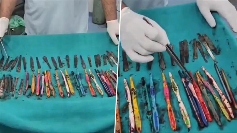 Uttar Pradesh De-Addiction Centre Horror: Patient Swallows 29 Spoons, 19 Toothbrushes and 2 Pens Over Anger at Food Scarcity, Undergoes Life-Saving Surgery in Hapur (Watch Video)