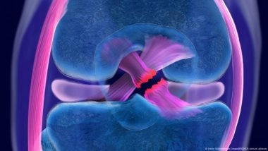 Cruciate Ligament Rupture: What You Need to Know